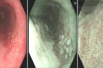 Nội soi cắt bỏ ung thư thực quản sớm không cần phẫu thuật