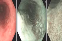 Nội soi cắt bỏ ung thư thực quản sớm không cần phẫu thuật