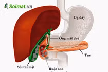 Cụ bà 77 tuổi nguy kịch vì sỏi túi mật gây tắc ruột non