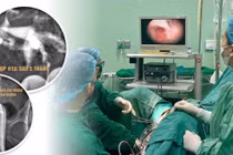 Giành lại thiên chức làm mẹ cho người phụ nữ dính buồng tử cung sau nạo thai