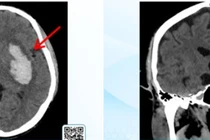 Đang uống cà phê đột ngột chóng mặt, méo miệng hôn mê