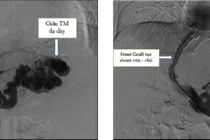Kỹ thuật TIPS chữa tăng áp lực tĩnh mạch cửa do xơ gan