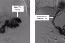 Kỹ thuật TIPS chữa tăng áp lực tĩnh mạch cửa do xơ gan
