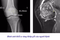 Chủ quan đau âm ỉ khớp gối, người đàn ông phát hiện u tế bào khổng lồ