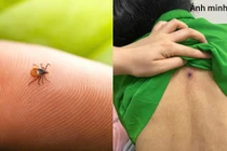 Tổn thương gan phổi khởi phát từ vết loét nhỏ tưởng chừng vô hại