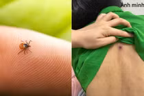 Tổn thương gan phổi khởi phát từ vết loét nhỏ tưởng chừng vô hại