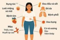 Co giật, rối loạn tâm thần... vì lupus ban đỏ ở trẻ