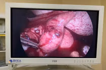 Chậm kinh 7 ngày, người phụ nữ đã triệt sản vỡ thai ngoài tử cung nguy kịch