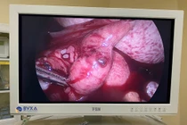 Chậm kinh 7 ngày, người phụ nữ đã triệt sản vỡ thai ngoài tử cung nguy kịch