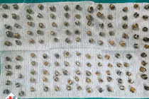 130 viên sỏi trong túi mật khiến người phụ nữ 40 tuổi viêm túi mật cấp