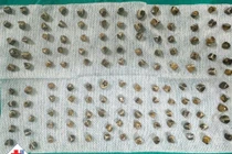 130 viên sỏi trong túi mật khiến người phụ nữ 40 tuổi viêm túi mật cấp