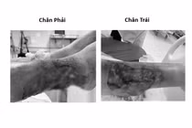 Suýt mất chi vì chủ quan lóc da cẳng chân do tai nạn