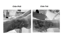 Suýt mất chi vì chủ quan lóc da cẳng chân do tai nạn