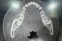 Đau vùng mặt trái, thiếu nữ 17 tuổi phát hiện u men phá hủy xương hàm