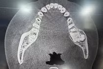 Đau vùng mặt trái, thiếu nữ 17 tuổi phát hiện u men phá hủy xương hàm