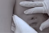 Vòng 1 hoại tử vì tiêm filler nâng ngực 