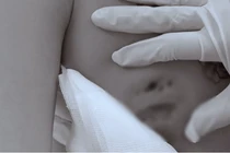 Vòng 1 hoại tử vì tiêm filler nâng ngực 