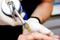 Liệu pháp lạnh - phương pháp điều trị hiệu quả trong da liễu