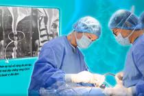 Giải ép tủy sống cho cụ bà 82 tuổi bị hẹp ống sống cổ nặng