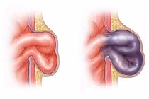 Một lần làm vườn, suýt mất ruột, biến chứng nguy hiểm của thoát vị bẹn