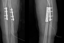 Ngã xe đạp trẻ 7 tuổi suýt mất vận động vì gãy kín