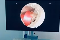 Dây buộc tóc cắm sâu vào ống tai bé gái 6 tuổi