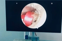 Dây buộc tóc cắm sâu vào ống tai bé gái 6 tuổi