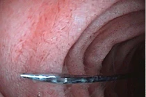 Kinh hoàng kim máy 4 cm trong đường tiêu hóa trẻ 11 tuổi