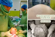 Đa u xơ tử cung kích thước lớn do dùng thực phẩm chức năng