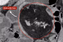 Sụt 10 kg vì bán tắc ruột tái phát hơn 1 năm không ngờ u mạc treo non