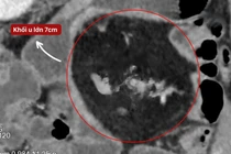 Sụt 10 kg vì bán tắc ruột tái phát hơn 1 năm không ngờ u mạc treo non