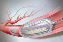 Cụ bà 91 tuổi thoát nguy cơ nhồi máu cơ tim nhờ nong bóng phủ thuốc