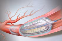 Cụ bà 91 tuổi thoát nguy cơ nhồi máu cơ tim nhờ nong bóng phủ thuốc