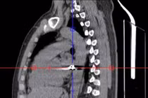 Cứu sống bệnh nhân bị đạn bắn xuyên ngực