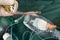 Hồi sức tim phổi 70 phút vẫn không cứu được bé 3 tuổi sặc thức ăn ở lớp