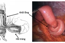 Cảnh báo lồng ruột ở trẻ nhỏ, cách xử trí