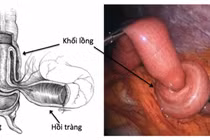 Cảnh báo lồng ruột ở trẻ nhỏ, cách xử trí