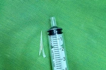 Lấy xương cá lớn 2 chạc trong thực quản người bệnh 49 tuổi