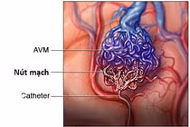 Địa chỉ vàng: Bệnh viện ở Hà Nội can thiệp dị dạng mạch máu