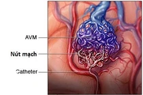 Địa chỉ vàng: Bệnh viện ở Hà Nội can thiệp dị dạng mạch máu