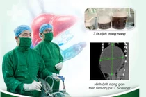 Hút hơn 3 lít dịch từ nang gan lành tính