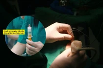 Đông cứng khớp vai... nguy cơ tàn phế