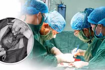 Bảo tồn tử cung cho sản phụ mắc rau cài răng lược thể nặng