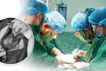 Bảo tồn tử cung cho sản phụ mắc rau cài răng lược thể nặng