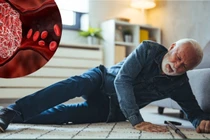 Nguy cơ ngã ở người cao tuổi, thuốc chống huyết khối có còn phù hợp?