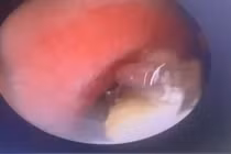 Nội soi gắp dị vật trong phế quản gốc của bệnh nhân