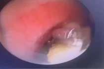 Nội soi gắp dị vật trong phế quản gốc của bệnh nhân