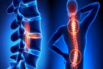 Đau lưng, tê bì đầu ngón tay… nguy cơ viêm tuỷ sống