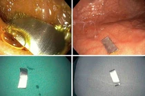 Bé 10 tháng suýt thủng ruột vì nuốt điếu thuốc lá chứa mảnh kim loại