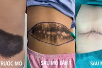 Mổ 2 lần lấy khối u sắc tố bẩm sinh khổng lổ cho trẻ 8 tuổi